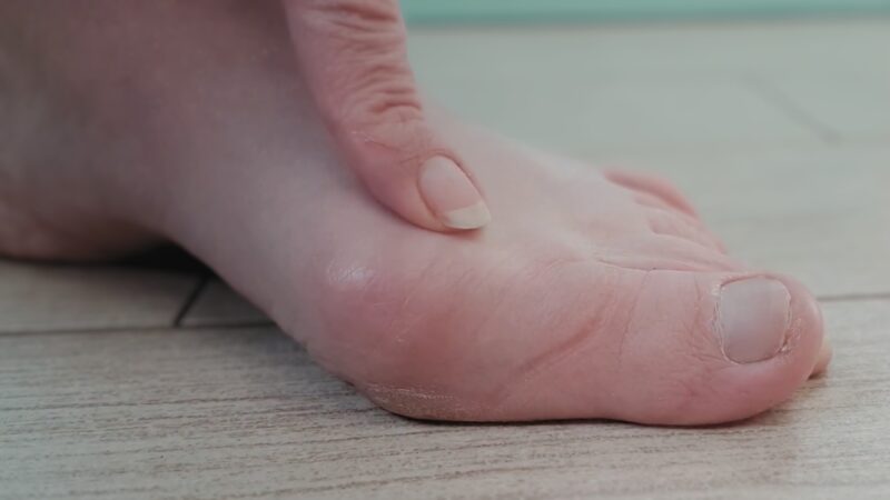 Symptoms and Diagnosis of A Bunion