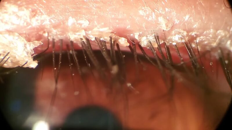 What Is Blepharitis